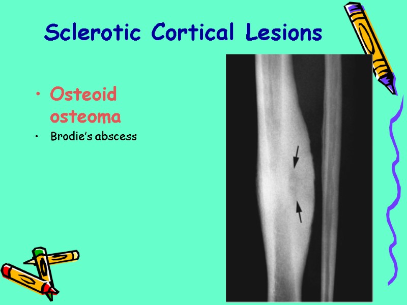 Sclerotic Cortical Lesions Osteoid osteoma Brodie’s abscess